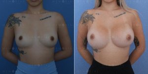 memorial-plastic-surgery-breast-augmentation-houston-texas-front-before-after-xaxftm6rwo9.jpg