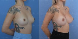 memorial-plastic-surgery-breast-augmentation-houston-texas-oblique-before-after-xaxftm6rwo9.jpg