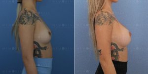 memorial-plastic-surgery-breast-augmentation-houston-texas-side-before-after-xaxftm6rwo9.jpg